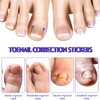 HOBKEY 140 Pieces Ingrown Toenail Stickers Correction Patches for Toenails