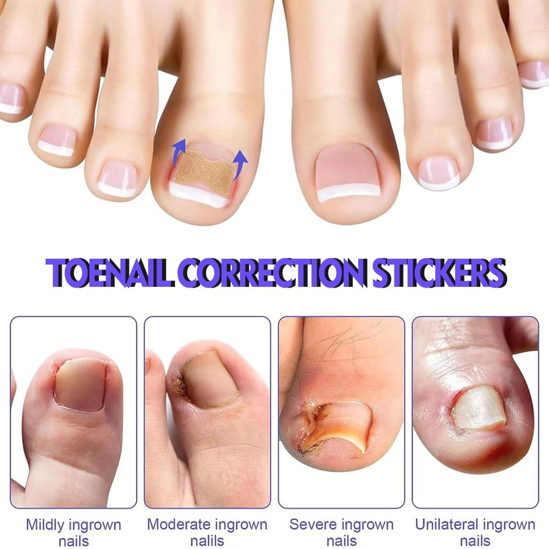 HOBKEY 140 Pieces Ingrown Toenail Stickers Correction Patches for Toenails