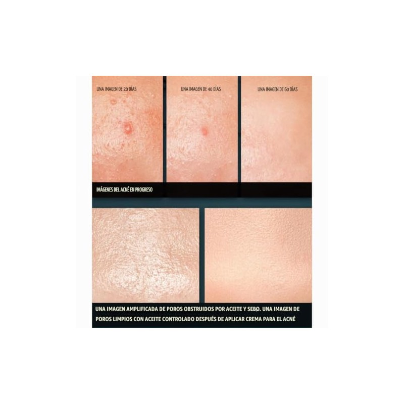 Pyunkang Yul - Crema para acné (50 ml)