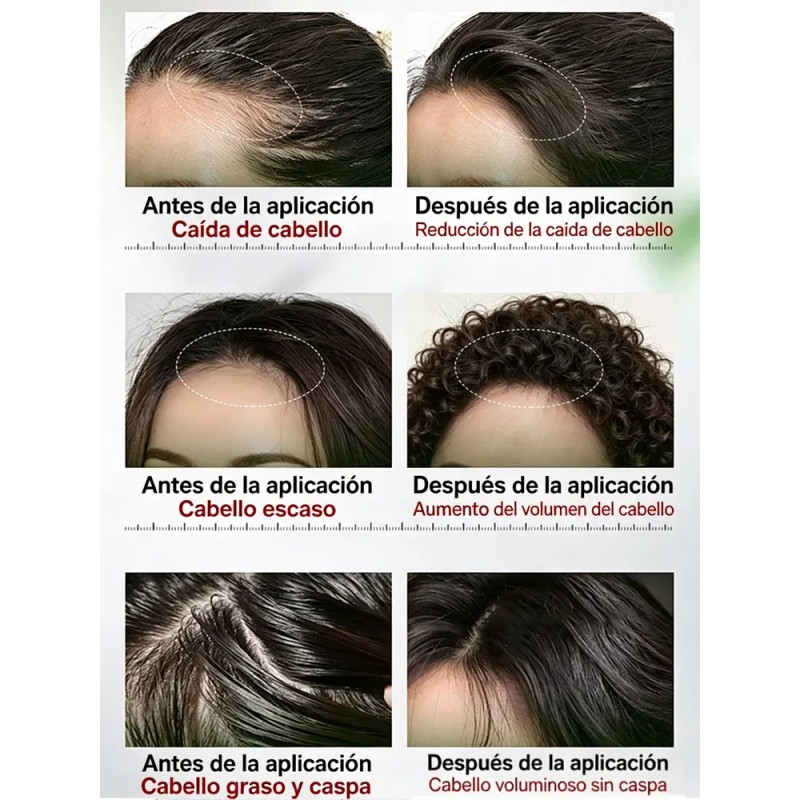 Sérum Crecimiento Cabello Calvicie Favorece Crecimiento 30ml