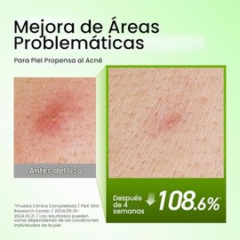 Anua Azelaic Acid 10 Hyaluron - Suero calmante para enrojecimiento, 1.01 onzas líquidas | Suero facial para piel propensa a manchas y grasa, cuidado d