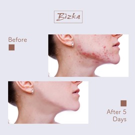 Bizka Gesichtscreme 30 g Creme für Akne, sehr leistungsstarke Gesichtscreme für fettige Haut – geeignet für alle Haut, reduziert Rötungen und verkleinert Poren