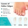 Does Not Apply Toe Separators: Correcting Bunions and Restoring Toes
