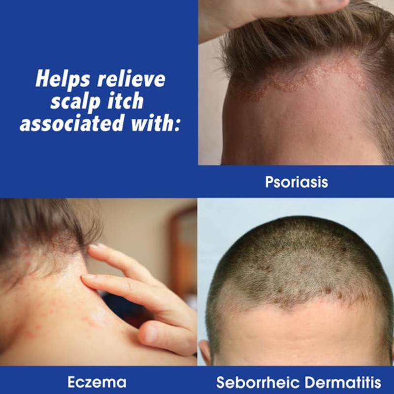 Scalpicin Max Strength Scalp Itch Treatment, 1.5 Ounce (Pack of