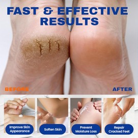 Urea Cream 40 percent for Feet with 2% Salicylic Acid, Maximum Strength & Intensive Repair Care for Dry Cracked Heels, Relief for Dry Foot, 5.29 OZ