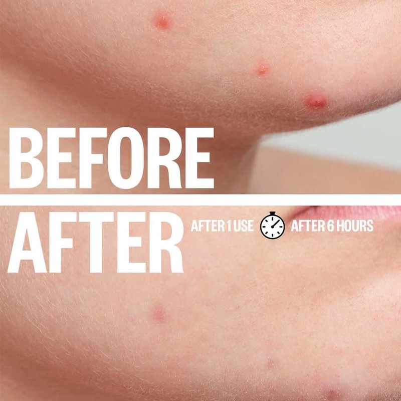 a.l.m. Magical Patch: Hydrocolloid pimple patches. These ultra thin &