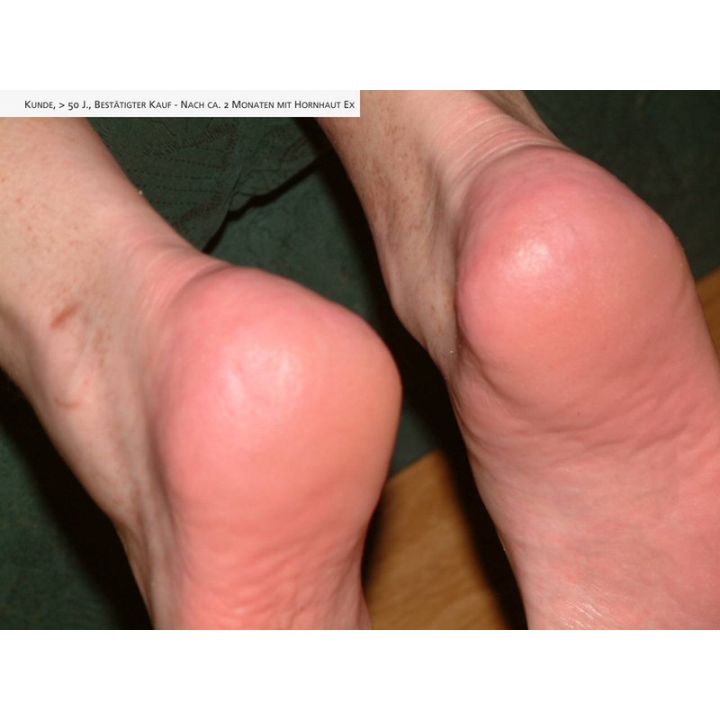 Naturprodukte Schwarz - Callus Ex - Callus Remover and Foot