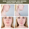 V-Line Lifting Chin Strap for Sleeping, Purely Physical and Side