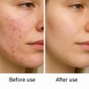 Golden Future Anti-Acne Revitalising Cream, Targeted Spot Treatment, Pimple Reducer