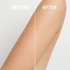 Microdermabrasion Keratosis Pilaris & Acne Exfoliating Deep Cleansing Face &