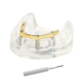 Dental Model Overdenture Transparent Dental Implants Model Detachable Model Lower Jaw Dental Teaching Model Suitable for Education and Study Golden