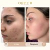 Crema Facial Hidratante Dermoaclaradora Anti Acne 4 Pack