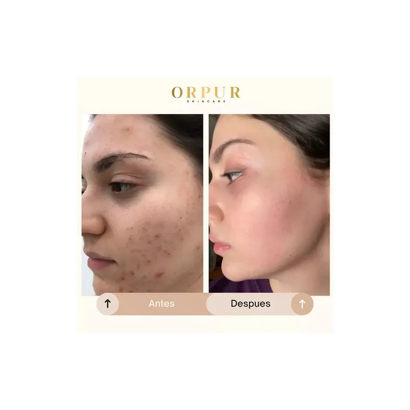 Crema Facial Hidratante Dermoaclaradora Anti Acne 4 Pack