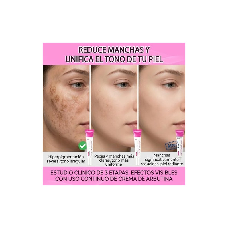 3pcs Crema Despigmentante Arbutina Ácido Tranexámico Aclarante Facial Manchas Oscuras