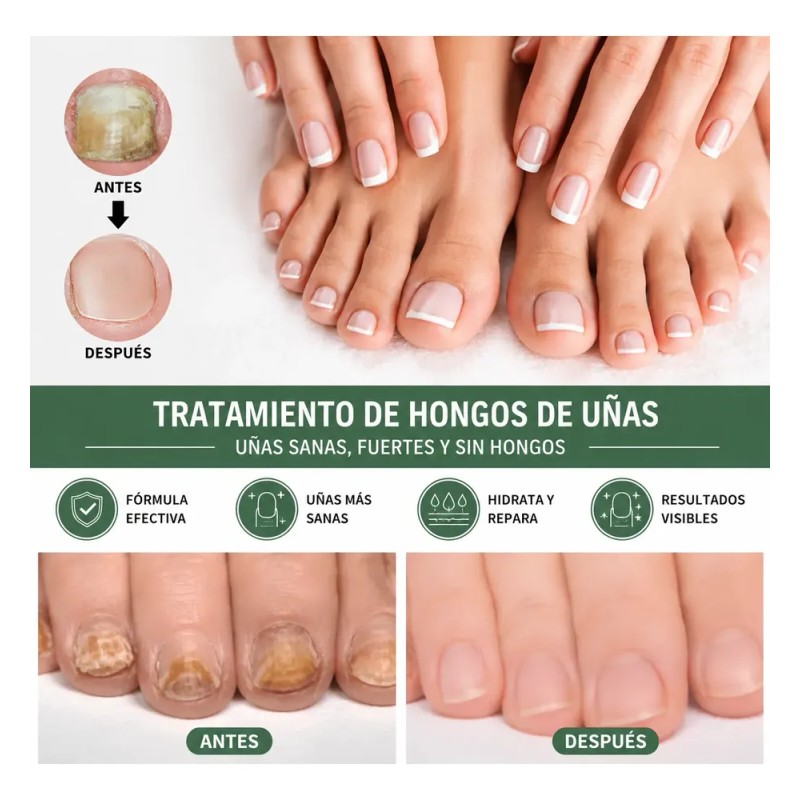 Eelho Líquido Para Hongos En Uñas Cura Hongos Y Onicomicosis