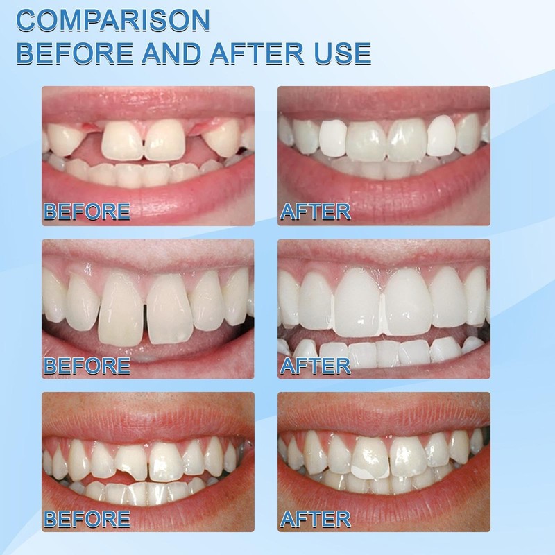 120pcs,Temporary Tooth Crown,Tooth Repair Kit,Temporary Crowns for Teeth,Temporary Tooth Filling,Denture