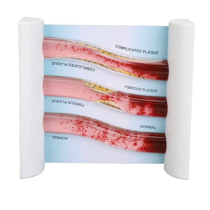 Lipoprotein LDL Blood Vessel Model Low Density Blood Lipid Vessel