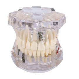 Dental Model, Dental Model, Implant Bridge Dental Dental Research Description Teaching Materials Learning (Life Size, Clear)