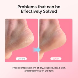 MelodySusie Moisturizing Heel Socks for Cracked Heel Treatment, Universal Style,Suitable for Home and Salon Use,Size Regular,Pink and Blue,2 Pairs