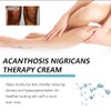 Bluemega Crema Acantosis Nigricans Loción Corporal Hidratante