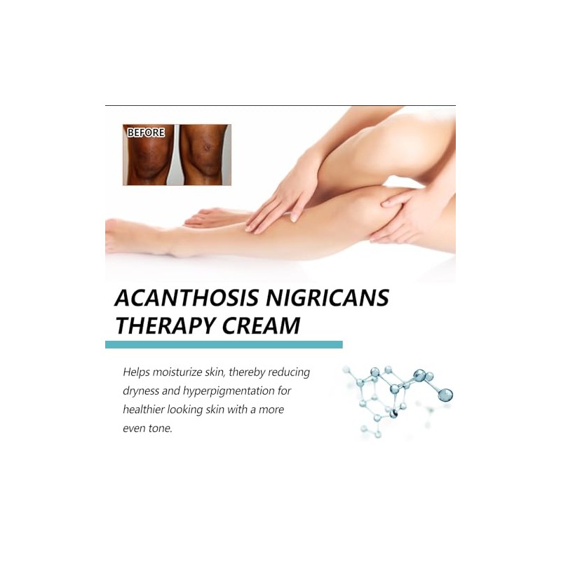 Bluemega Crema Acantosis Nigricans Loción Corporal Hidratante