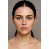 Limpiador Para Control De Acné Espuma Tratamiento Skincare