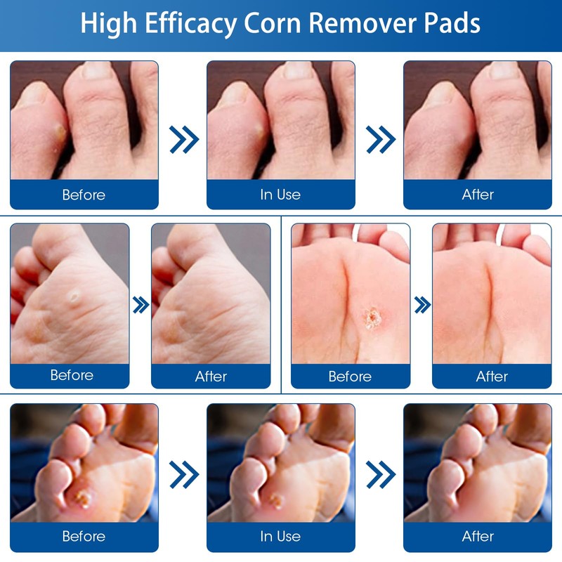 24 Count Corn Removal Pads for Feet and Toe, Corn