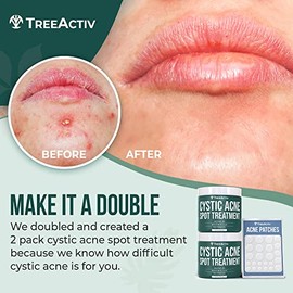 Cystic Acne 2-Pack