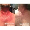 Intense Treatment for Eczema Rosacea cream Eczemaout Acne 4oz
