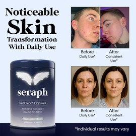 Seraph Acne Supplement - Hormonal Acne Pills Treatment - Pimple Supplements for Women - Skin Care Supplement for Teen, Men, & Adults - Made in USA - 60 Tablets