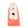 Tankredrug 4 Times Caries Evolution Model Detachable Teeth Disease Teach