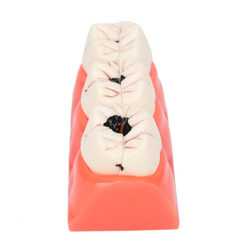 Tankredrug 4 Times Caries Evolution Model Detachable Teeth Disease Teach