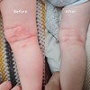 Salcura, Bioskin Junior Outbreak Rescue Cream, Packed With Natural Ingredients,