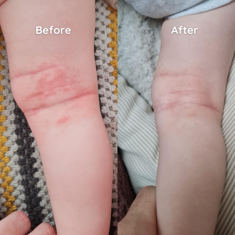 Salcura, Bioskin Junior Outbreak Rescue Cream, Packed With Natural Ingredients,