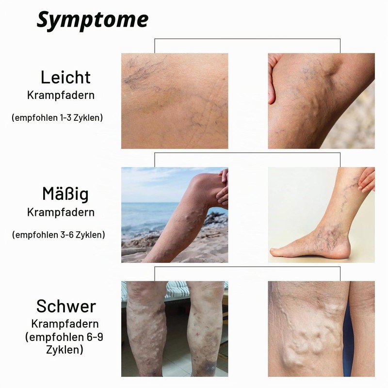 Varicose Veins Cream, Spider Vein Removal, Gentle Leg Care, Improves