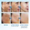 Abera Dark Spot Serum for Face, Dark Spot Corrector, Melasma