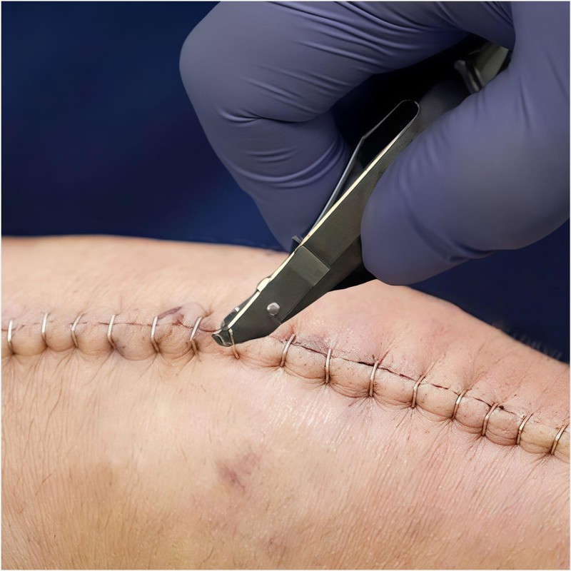 Skin Staple Remover Tool - Surgical Grade Stainless Steel Staple