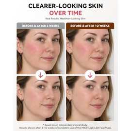 Máscara Facial de Terapia de Luz Roja y Azul para Acné y Arrugas, Máscara LED Facial con 432 LEDs y Cobertura Completa, 3 Modos de Luz para Cuidado Fa