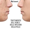 Vitamol Biosoft Pimple, Acne and Blackhead Treatment Cream - 40ml