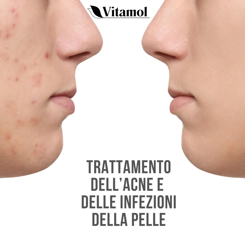 Vitamol Biosoft Pimple, Acne and Blackhead Treatment Cream - 40ml