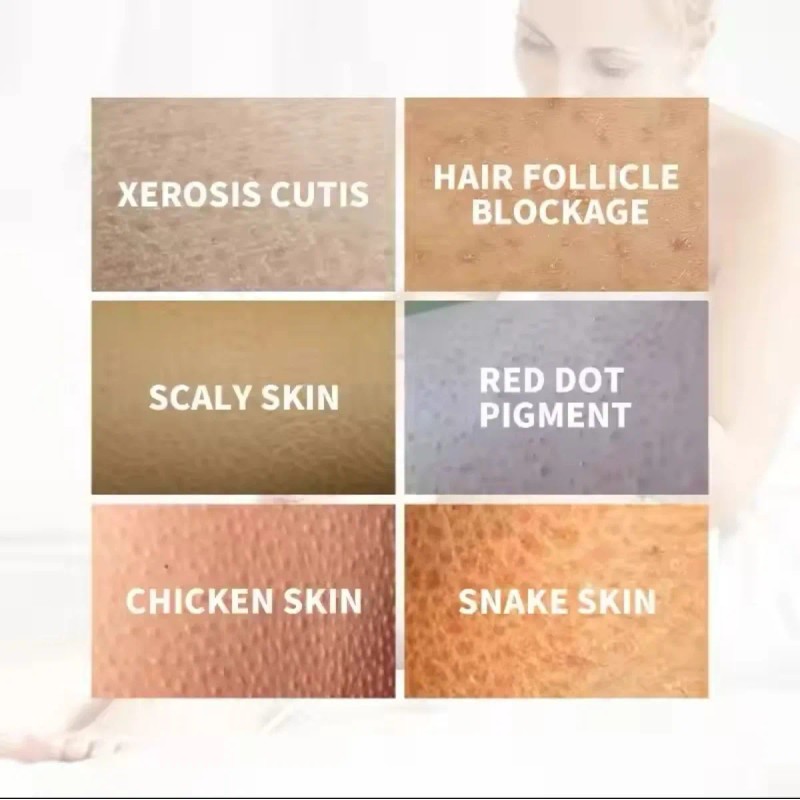 Crema Antibacteriana Psoriasis Eczema Rash Rojo Dermastitis