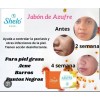 Olvídate Del Acné Y Ten Un Cutis Más Limpio