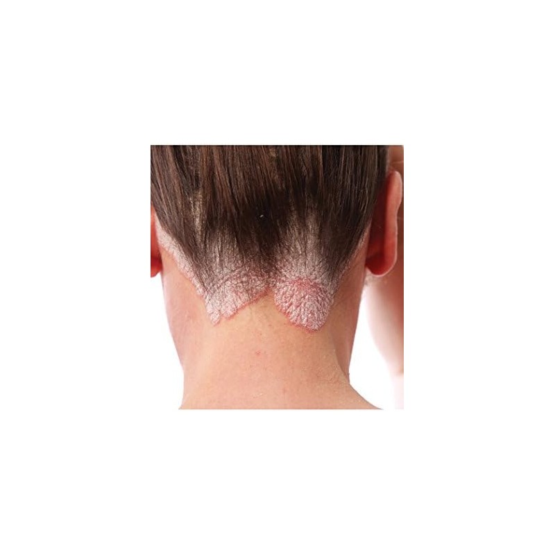 Psoriasis Control Shampoo
