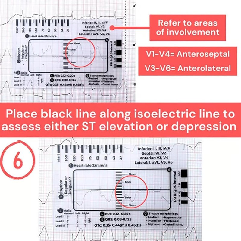 1Pc ECG 7 Step Ruler, ECG 7 Step Ruler for