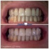 Crystal Clear Blanqueador De Dientes Laser Gel KIT Profesional Dientes