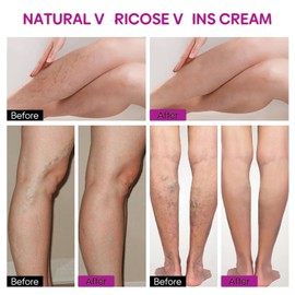 Professional Leg Treatment Cream,Va/Ricose V/Eins Cream,Varico/se Ve/ins Treatment Cre/am,Skin Repair Crea/m,Crea/m for Varic/ose Vei/ns,Ve/in Crea/m for Legs