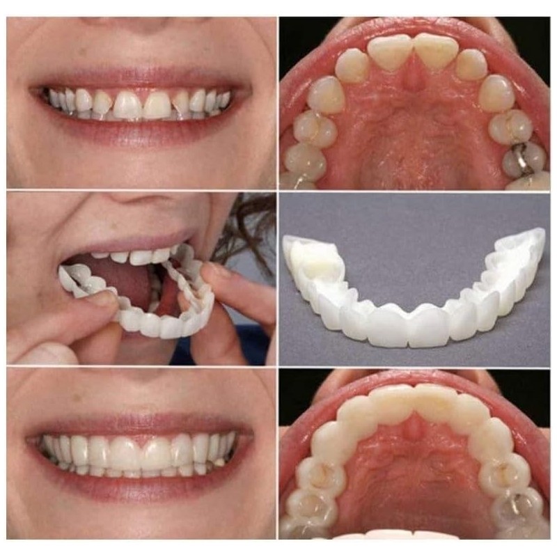 Adjustable Smile Supports - 2 Pairs (Top & Bottom) |