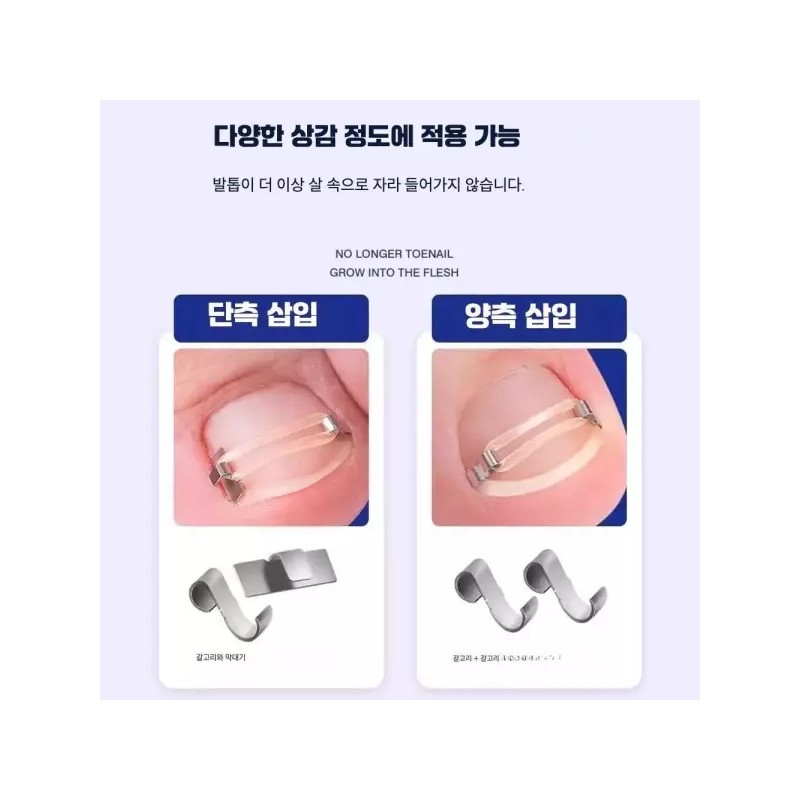 내성발톱교정기 발톱교정기 엄지발톱 내성손톱 [교정기 2개] Ingrown Toenail Correction Device,