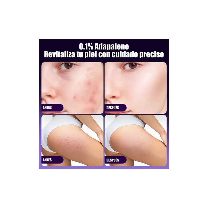 Gel Facial Anti-piel Acne Contiene Adapalene Para Piel Acne