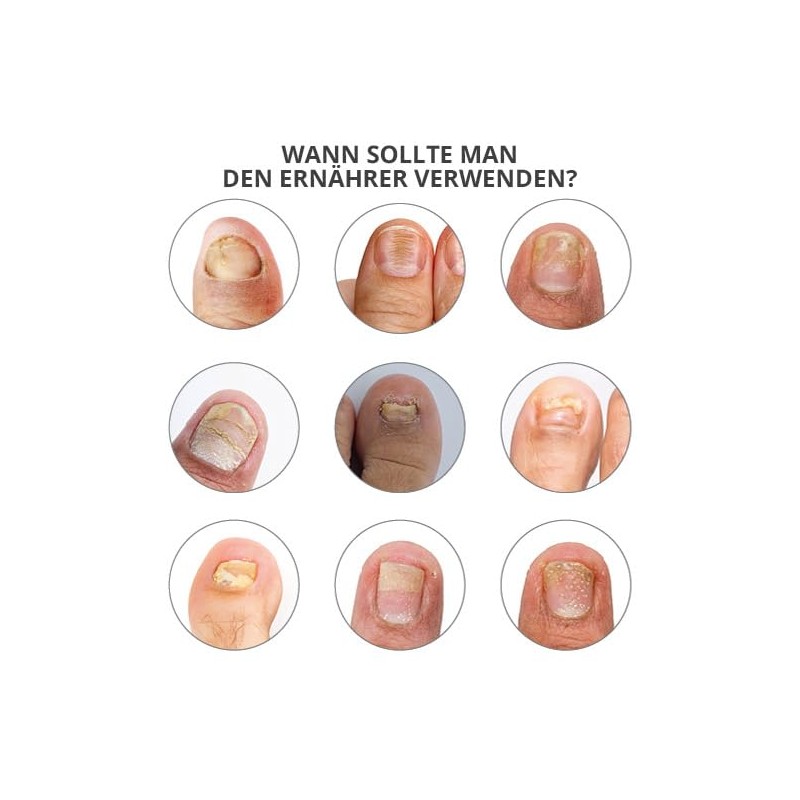 Grooved, dry, brittle nails, 30 ml, Ongles Abimes, Nourrissant Poderm